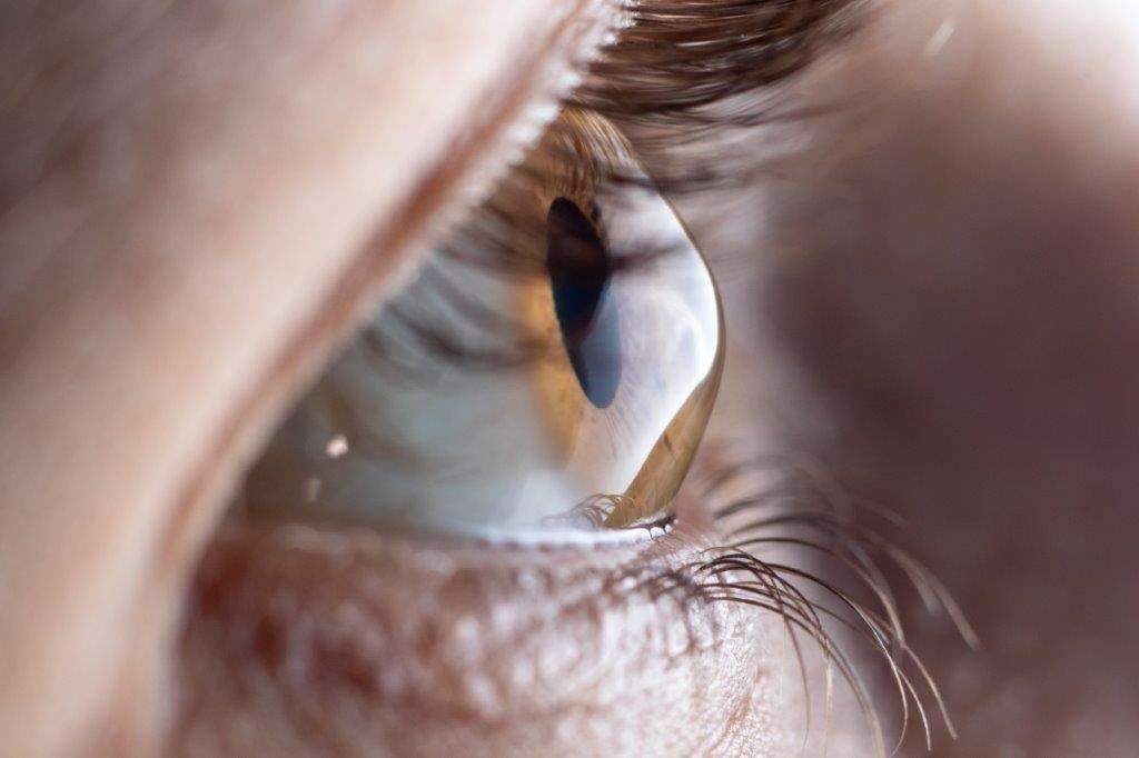 What is Keratoconus?